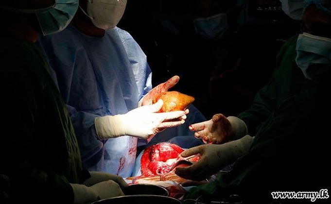 Médicos retiram maior e mais pesada pedra no rim do mundo