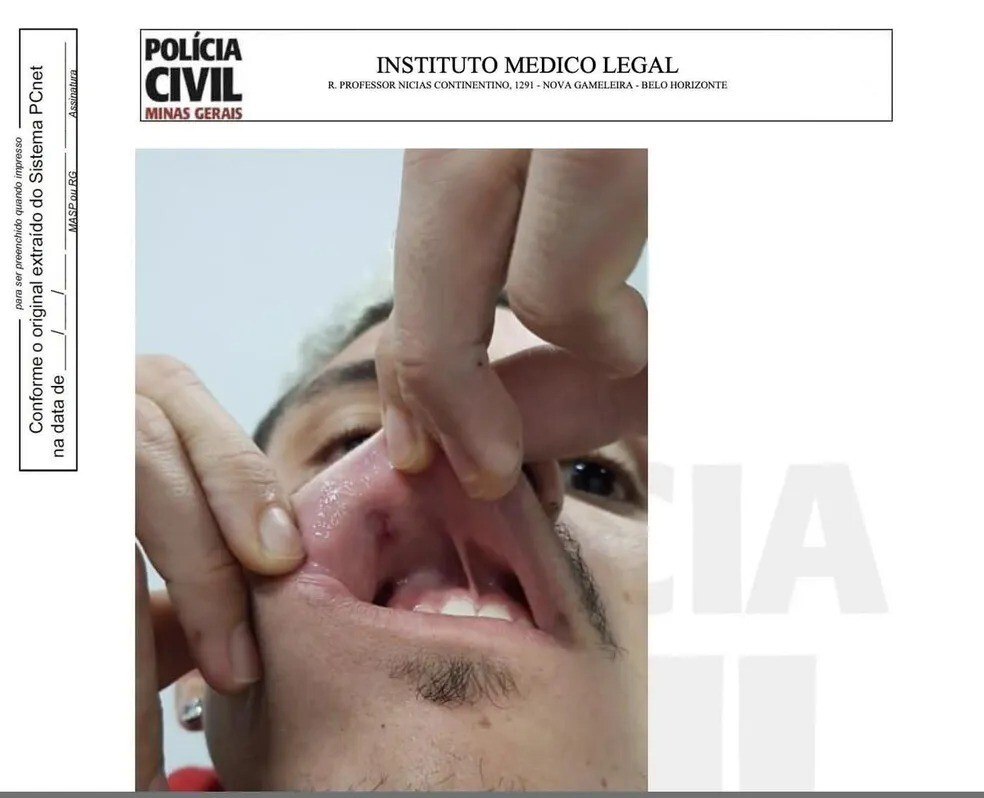 Pedro mostrando o corte na boca pelo soco que levou de Fernández. Flamengo virou caso de polícia