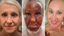 Peeling bizarro que viralizou na web promete rejuvenescer a pele em até 20 anos; saiba os riscos