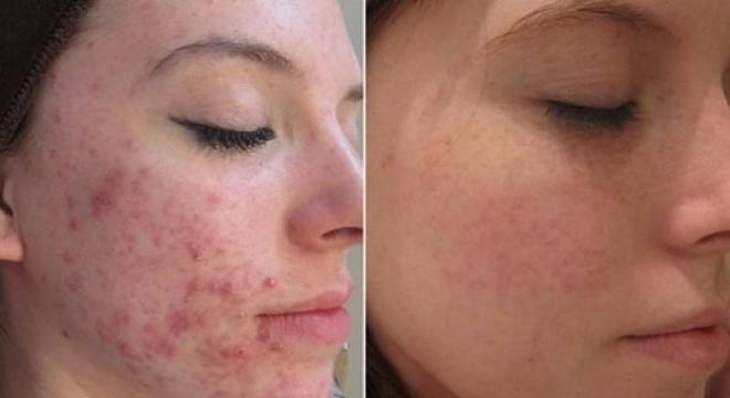 Peeling químico - o que é, benefícios, quem pode fazer e cuidados