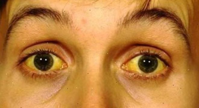 Pele amarelada - principais condições de saúde que provocam a mudança