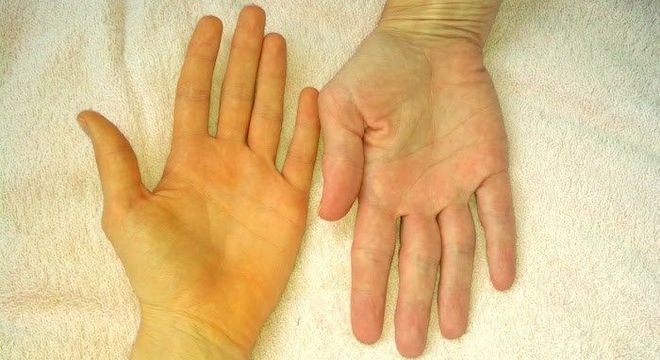 Pele amarelada - principais condições de saúde que provocam a mudança
