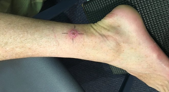 Só no estado de Victoria foram registrados 275 novos casos no ano passado, aumento de 51% em relação a 2016