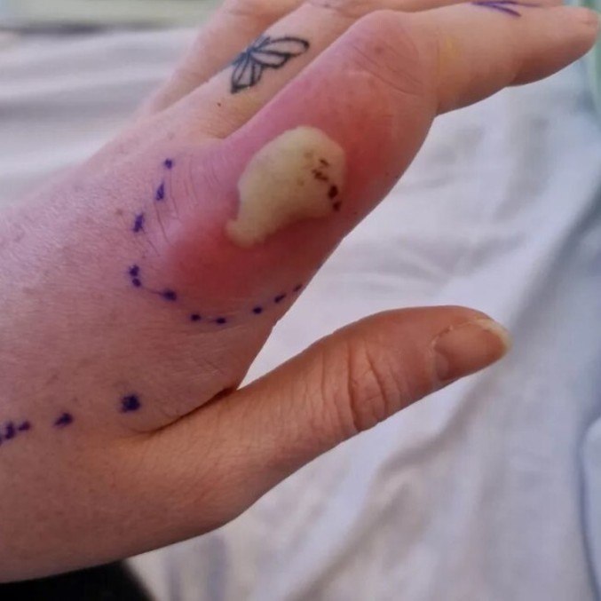 Mulher achou que tinha mancha no dedo, mas era mordida de aranha venenosa