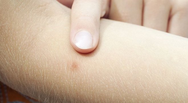 Pele humana é mais fácil de ser perfurada por um mosquito do que a de outros vertebrados