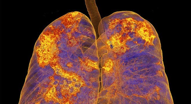 Imagem dos pulmões de uma pessoa infectada mostra áreas com pneumonia