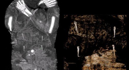 Raio-X revelou um feto no ventre da múmia 
