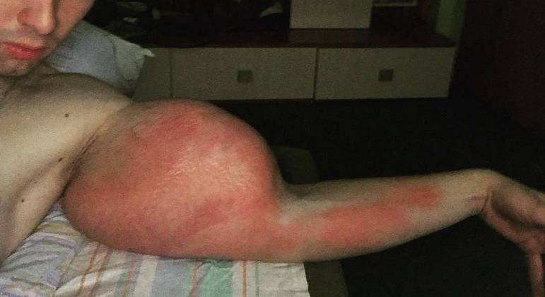 Tereshin ganhou os notíciarios após ter inflado e deformado os braços com vaselina
