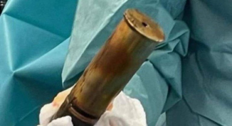 Idoso de 88 anos estava com bomba da Primeira Guerra Mundial presa no reto