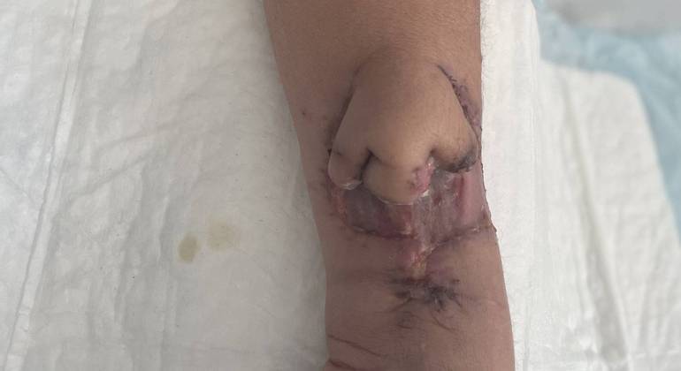 Com uma prótese de biomaterial, os médicos 'cultivaram' um novo nariz para a paciente