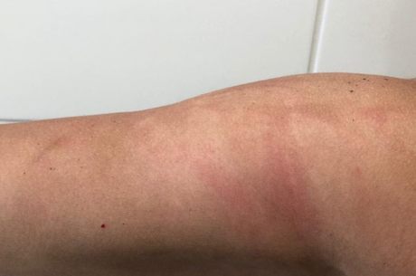 A má aplicação do filtro solar pode deixar a pele manchada 