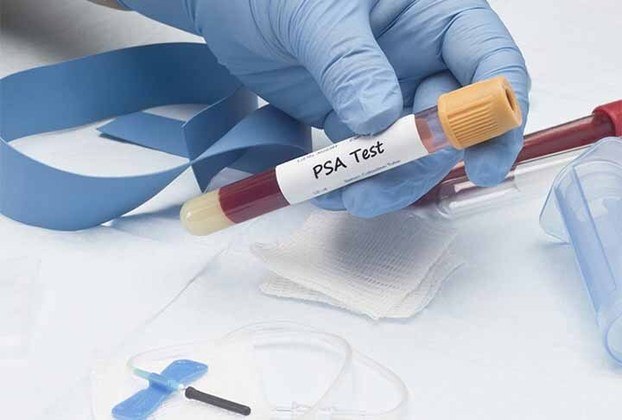 PSA: Teste laboratorial que mede a quantidade de PSA no sangue. O PSA é uma proteína produzida pela próstata, uma glândula localizada abaixo da bexiga, que faz parte do sistema reprodutor masculino. 