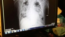 Transplante pulmonar duplo salva doente de 31 anos no pós-covid