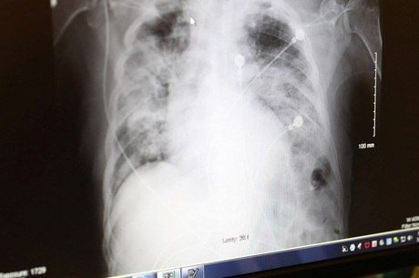 Raio-x mostra pulmões de paciente com covid-19
