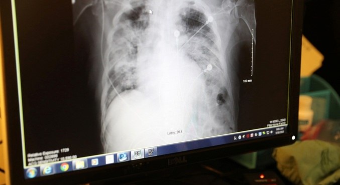 Exame de imagem mostra pulmão de paciente de covid-19 comprometido