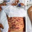 Jovem come sobra de refeição do colega e tem infecção severa (New England Journal of Medicine)