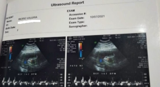 Ultrassom de hospital particular apontava gravidez de gêmeas em julho de 2021