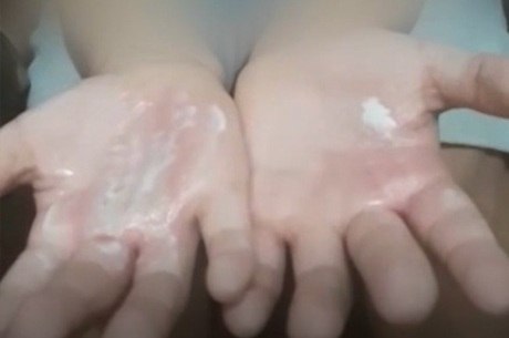 Menina de 7 anos teve as mãos queimadas