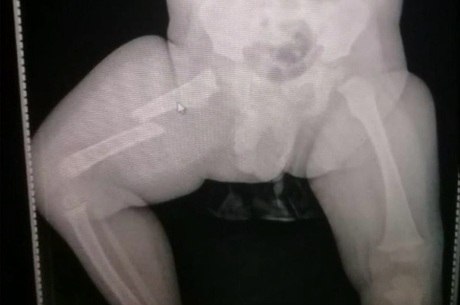 Raio-x identificou lesão na perna da criança