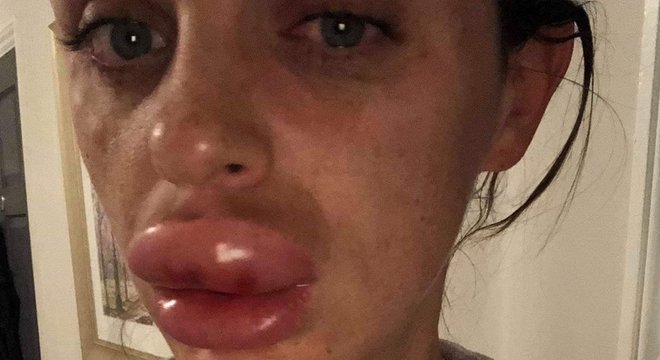 Rachael Knappier nÃ£o saiu de casa por uma semana depois que seus lÃ¡bios incharam muito por causa de um erro na aplicaÃ§Ã£o de preenchimento labial