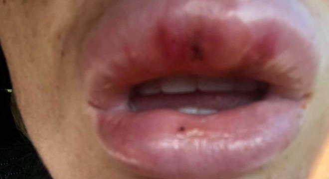 Knappier disse que seus lábios estavam tão inchados que chegaram a tocar no seu nariz

