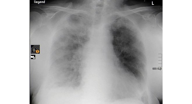  Raio X mostra pulmões de idosa de 84 anos, internada em hospital de Berlim, comprometidos pela covid-19

