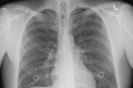 Pneumonia é infecção que afeta bolsas de ar do pulmão