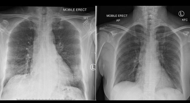  Raios-x dos pulmões de paciente mostraram a recuperação após aparecimento de células do sistema imonológico

