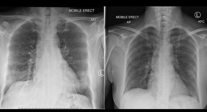 Raios-x dos pulmões de paciente mostraram a recuperação após aparecimento de células do sistema imonológico