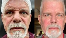 Raul Gazolla mostra antes e depois de harmonização facial: 'Rejuvenescendo com naturalidade'
