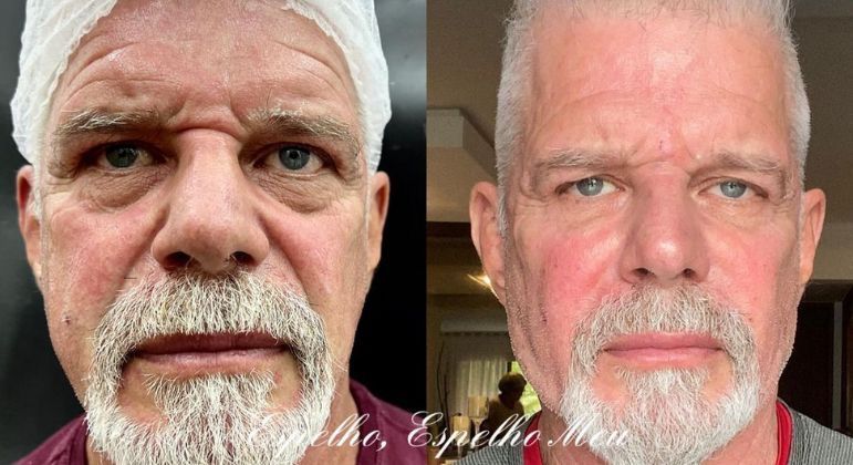Raul Gazolla passa por harmonização facial