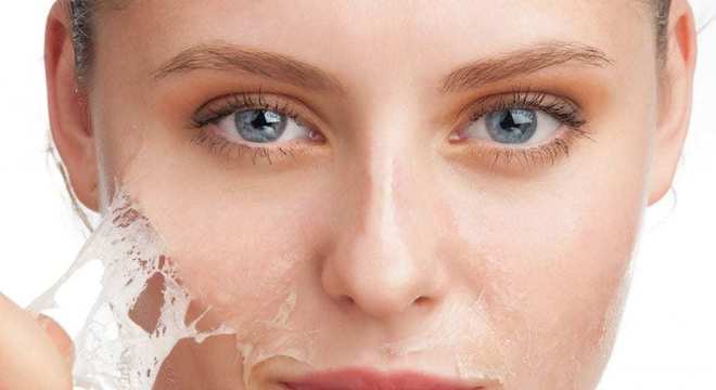 Remédio para melasma - saiba as melhores formas de tratamento