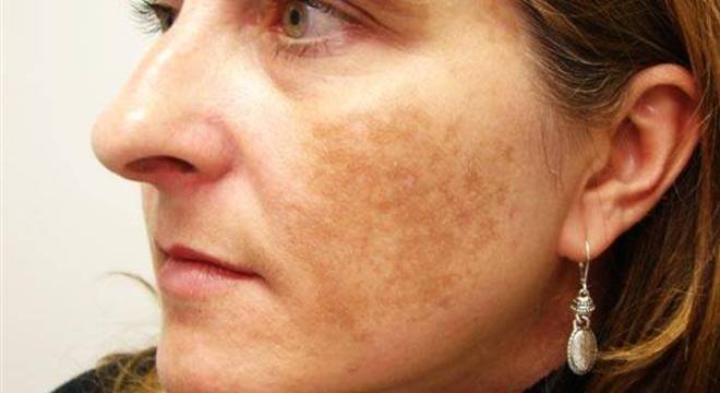 Remédio para melasma - saiba as melhores formas de tratamento