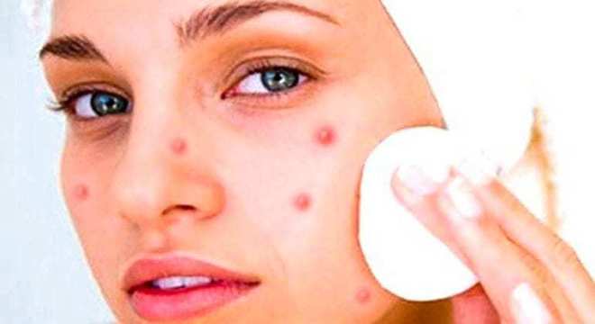 Remédios caseiros para espinha - receitas para acabar com o problema