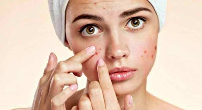 Remédios caseiros para espinha - receitas para acabar com o problema