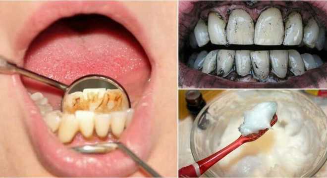 remdios caseiros para remover a placa bacteriana e o trtaro dos dentes