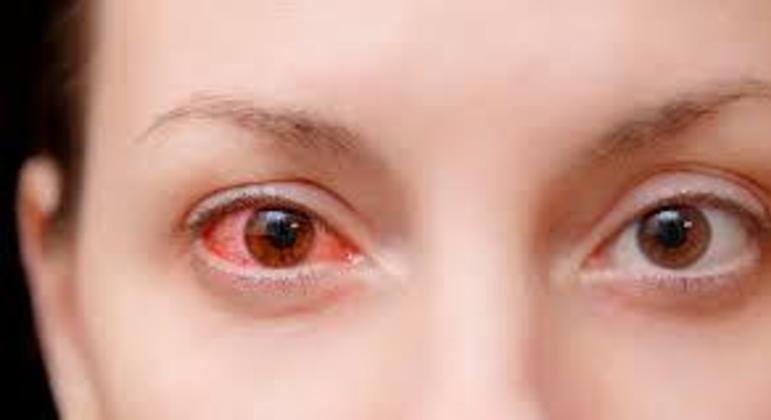 Remela - como são formadas e principais causas de acúmulo nos olhos