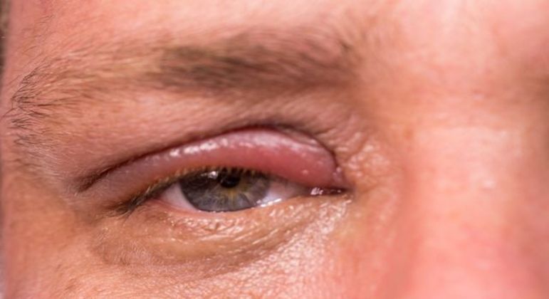Remela - como são formadas e principais causas de acúmulo nos olhos