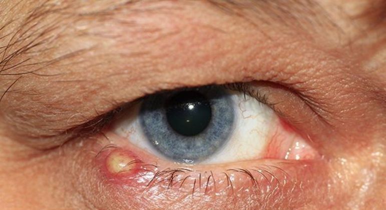 Remela - como são formadas e principais causas de acúmulo nos olhos
