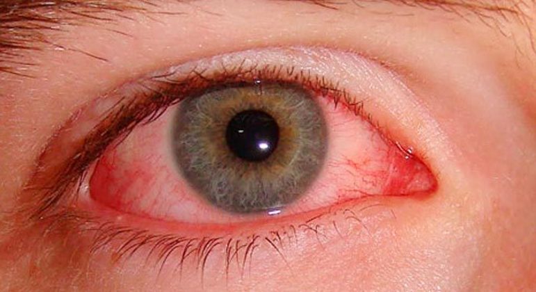 Remela - como são formadas e principais causas de acúmulo nos olhos