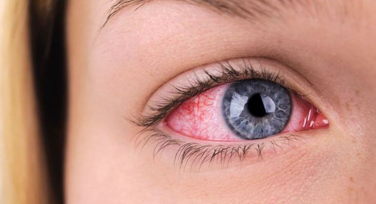 Remela - como são formadas e principais causas de acúmulo nos olhos