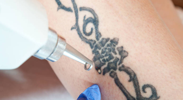 remoção de tatuagem a laser