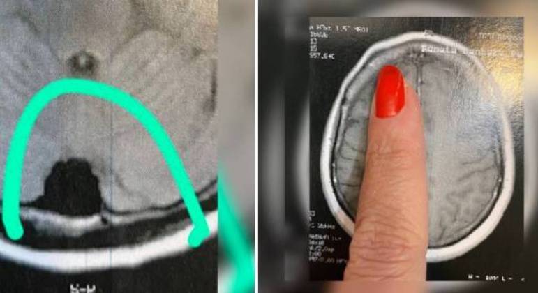 À esq., Renata mostra tumor de 2 cm; à dir., o estufamento ósseo localizado na testa