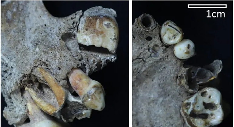 Dentes de esqueleto de quase 10 mil anos ajudaram cientistas a chegar à descoberta