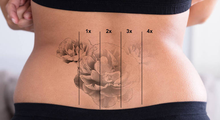 resultado laser tatuagem