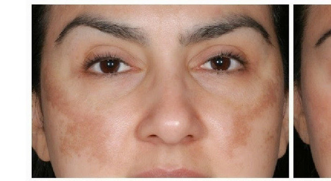 Retinol - o que é, para o que serve, como usar, melhores produtos