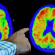 Falta de diagnósticos para Alzheimer preocupa especialistas (Brian Snyder/Reuters – 30.03.2023 )