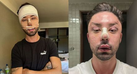 Rico Melquiades mostra pós-operatório de cirurgia plástica no rosto