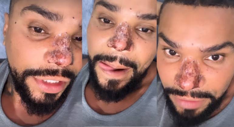 Nariz do cantor Naldo Benny está com princípio de necrose