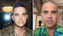 Robbie Williams diz que vai começar a usar perucas após transplante capilar malsucedido
